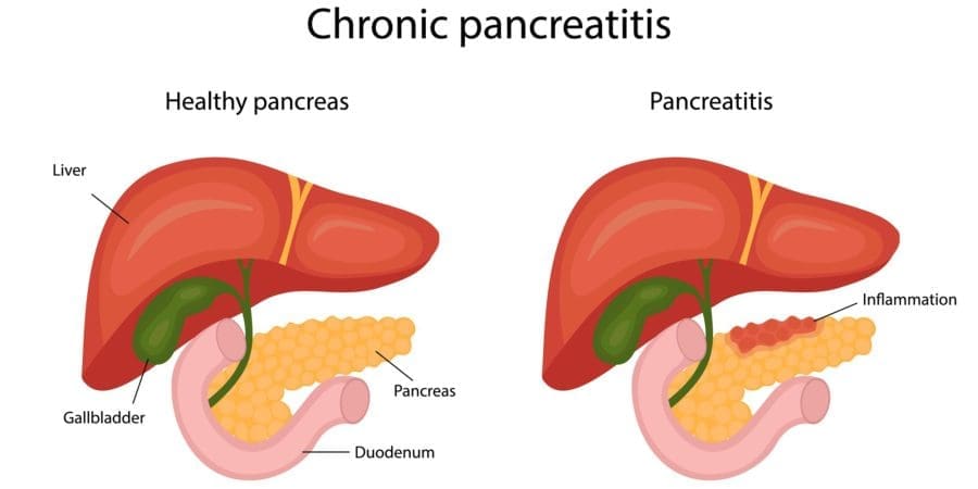 Chronic Pancreatitis healthy vs Inflamed - infographic